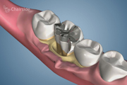 Broken Tooth Non Restorable
